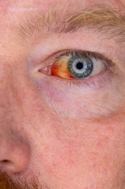 Gözdeki damar zedelenmiş. İnsan gözünde kan. El feneriyle kapatılmış.. 