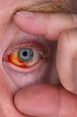 Gözdeki damar zedelenmiş. İnsan gözünde kan. El feneriyle kapatılmış.. 