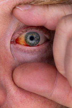 Gözdeki damar zedelenmiş. İnsan gözünde kan. El feneriyle kapatılmış.. 