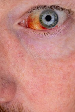 Gözdeki damar zedelenmiş. İnsan gözünde kan. El feneriyle kapatılmış.. 
