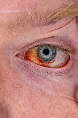 Gözdeki damar zedelenmiş. İnsan gözünde kan. El feneriyle kapatılmış.. 