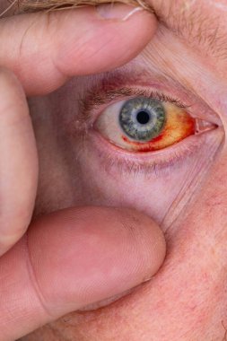 Gözdeki damar zedelenmiş. İnsan gözünde kan. El feneriyle kapatılmış.. 