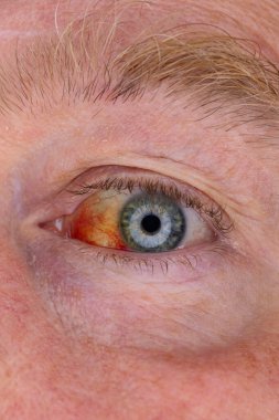 Gözdeki damar zedelenmiş. İnsan gözünde kan. El feneriyle kapatılmış.. 