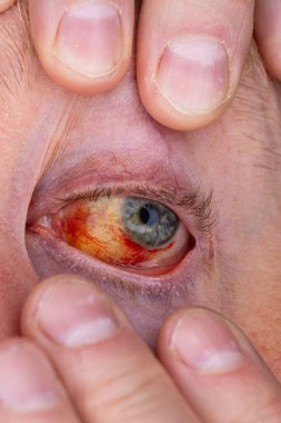 Gözdeki damar zedelenmiş. İnsan gözünde kan. El feneriyle kapatılmış.. 