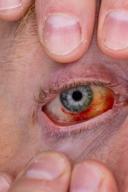 Gözdeki damar zedelenmiş. İnsan gözünde kan. El feneriyle kapatılmış.. 
