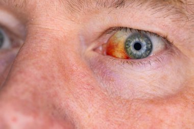 Gözdeki damar zedelenmiş. İnsan gözünde kan. El feneriyle kapatılmış.. 