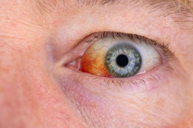 Gözdeki damar zedelenmiş. İnsan gözünde kan. El feneriyle kapatılmış.. 