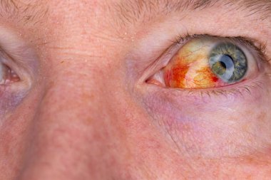 Gözdeki damar zedelenmiş. İnsan gözünde kan. El feneriyle kapatılmış.. 