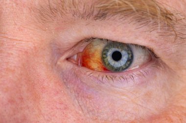 Gözdeki damar zedelenmiş. İnsan gözünde kan. El feneriyle kapatılmış.. 