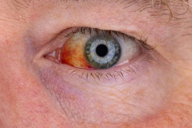 Gözdeki damar zedelenmiş. İnsan gözünde kan. El feneriyle kapatılmış.. 