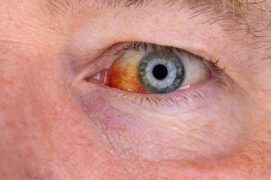Gözdeki damar zedelenmiş. İnsan gözünde kan. El feneriyle kapatılmış.. 