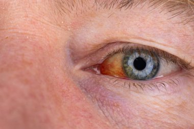 Gözdeki damar zedelenmiş. İnsan gözünde kan. El feneriyle kapatılmış.. 