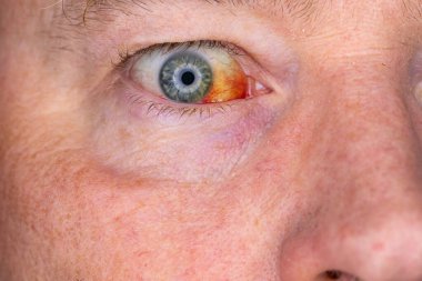 Gözdeki damar zedelenmiş. İnsan gözünde kan. El feneriyle kapatılmış.. 