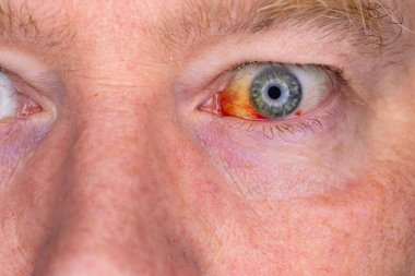 Gözdeki damar zedelenmiş. İnsan gözünde kan. El feneriyle kapatılmış.. 