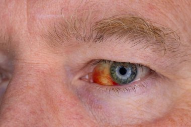 Gözdeki damar zedelenmiş. İnsan gözünde kan. El feneriyle kapatılmış.. 