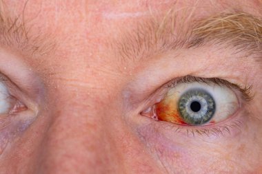 Gözdeki damar zedelenmiş. İnsan gözünde kan. El feneriyle kapatılmış.. 