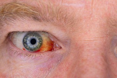 Gözdeki damar zedelenmiş. İnsan gözünde kan. El feneriyle kapatılmış.. 