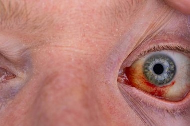 Gözdeki damar zedelenmiş. İnsan gözünde kan. El feneriyle kapatılmış.. 