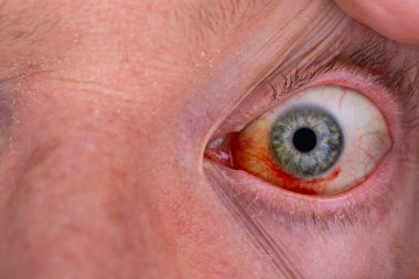 Gözdeki damar zedelenmiş. İnsan gözünde kan. El feneriyle kapatılmış.. 