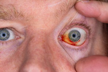 Gözdeki damar zedelenmiş. İnsan gözünde kan. El feneriyle kapatılmış.. 