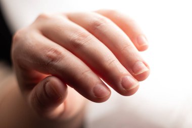 Kuru deri ve şeytan tırnağı olan kadın ellerini kapat. Kısa tırnaklar. Tırnak etleri kötü durumda. Kötü manikür..