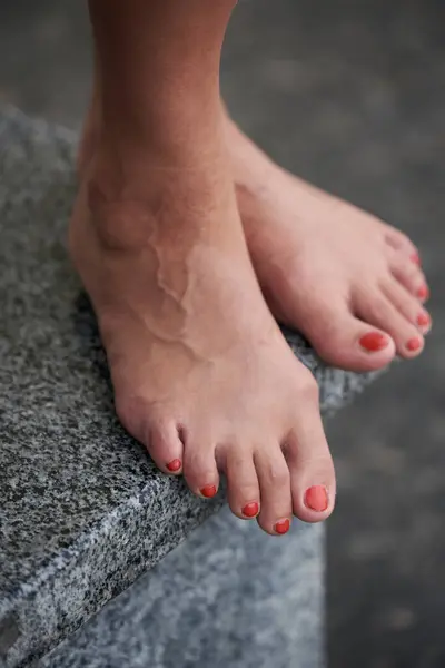 Female legs with swollen veins on the legs. Woman standing on a marble step in the city