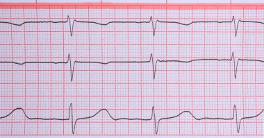 Elektrokardiyogram grafiği, şebeke kağıdında kalp atışlarını gösteriyor. Çoklu amaçlar için çok yönlü resim