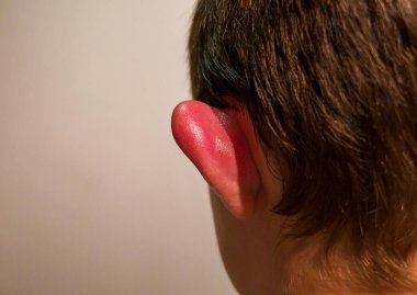 Erkek kulağı şişmiş, kırmızı, sıcak bir dokunuş çünkü sivrisinek ısırıyor. Sivrisinek ya da böcekler kanımızla ziyafet çeker ve sonra deride kaşıntıya neden olan bir tükürük bırakır..