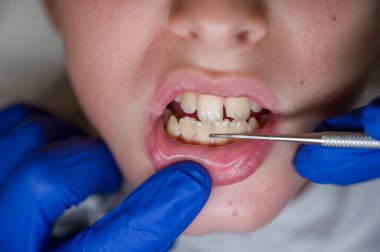 Dişçide tartar temizleyen bir çocuğun ağzını aç.
