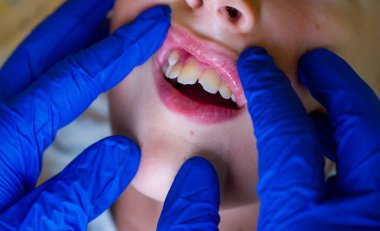 Diş hekiminde dişlerini gösteren bir çocuğun ağzı açık.