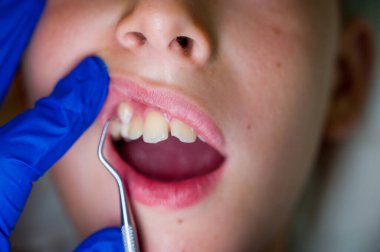 Diş hekiminde dişlerini gösteren bir çocuğun ağzı açık.