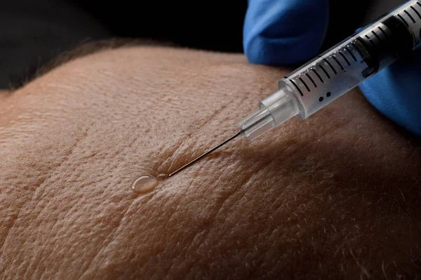 Macro photo of caucasian female forehead and a syringe with a needle making an injection of botox in the skin.
