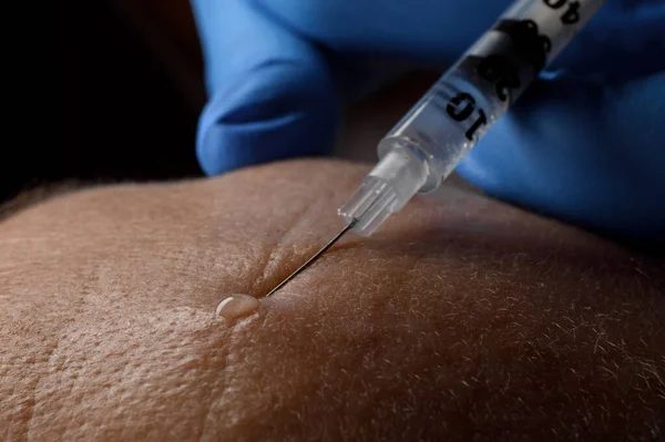 close-up of caucasian female forehead and a syringe with a needle making an injection of botox in the skin. Macro photography