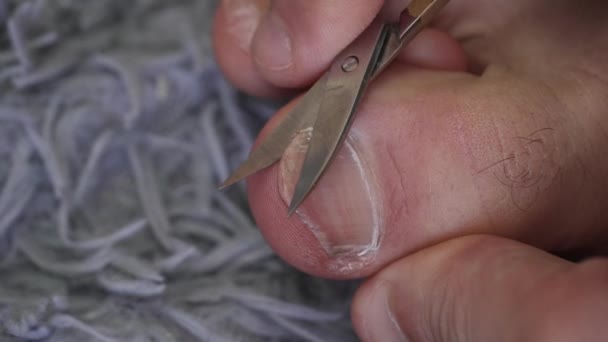 Nagelschnitt Fuß Des Menschen Nahaufnahme Pilzinfektion Nagelbeinen Finger Mit Onychomykose — Stockvideo