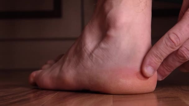 Крупный План Мужских Ног Мозолями Ранами Волдырями Вызванными Ношением Неудобной — стоковое видео