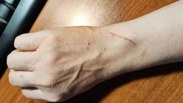 Hand of woman with scratches made by a cat. Minor injuries to the hand. Aggressive animal