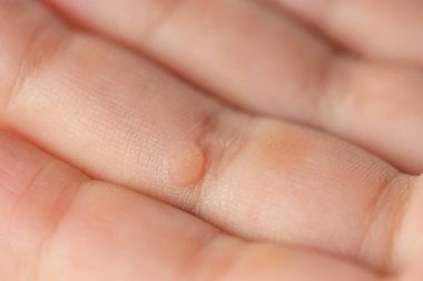 Parmağında siğil var. Bir çocuğun parmağındaki siğilin yakın çekimi. Verruca vulgaris yaygın bir siğil, bir tür papillomavirus olan HPV 'den kaynaklanır.