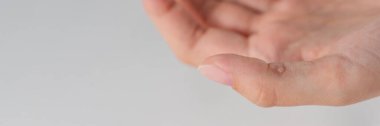 Wart on hand. The concept of treating warts and other skin defects. Close-up of a wart on a finger, a benign growth on human skin clipart