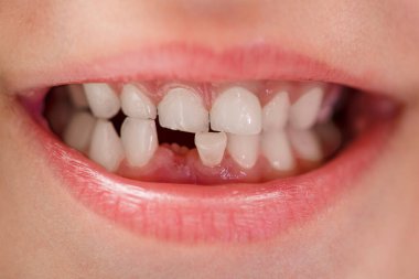 Childrens smile. Smile of a child 6 years old without a tooth, close-up. Loss of childrens teeth. Dental care and oral hygiene in children