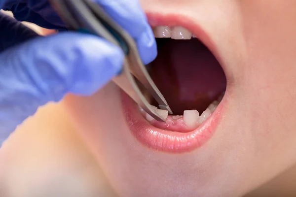 Childrens teeth. The doctor extracts a childs tooth. Milk teeth in a child, close-up.