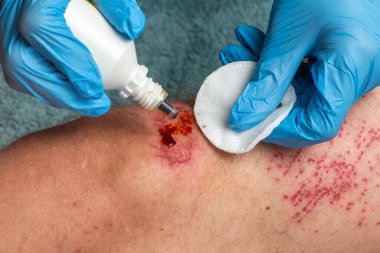 Elektrikli scooterlar yüzünden yaralanma riski var. Elektrikli scooterdan düşen bir adamın yarasını bir doktor tedavi eder. Yüksek kalite fotoğraf