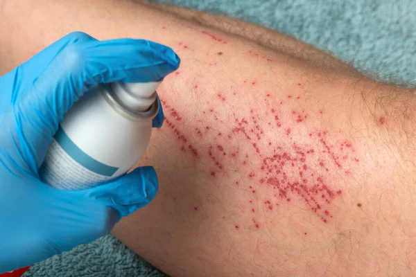 The doctors hand applies disinfectant foam to the leg. A doctor treats a cyclists leg injury who fell off his bike with disinfectant foam and cotton. High quality photo