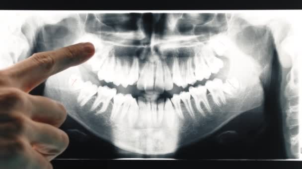 Die Hand Eines Zahnarztes Analysiert Die Röntgenbilder Der Zähne — Stockvideo