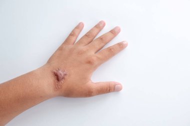 Sırtında hipertrofik Keloid izi olan beyaz arka planda genç bir kadın var.
