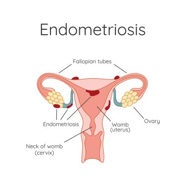 Endometriosis. The appearance of the disease endometriosis. Endometrium. Infographic clipart