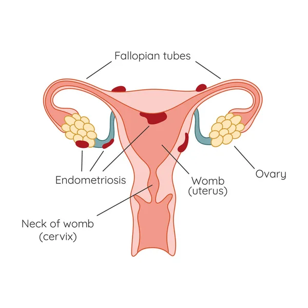 Эндометриоз Появление Эндометриоза Заболевания Эндометриум Инфографика — стоковое фото