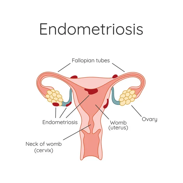 Endometrios Utseendet Sjukdomen Endometrios Endometrium Informationsgrafik — Stockfoto