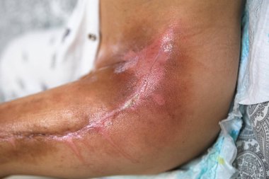 Burned area on the leg following radiotherapy, surgery to remove the cancerous tumor