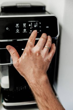 Eşsiz Eller İş Başında: Vitiligo Çeşitliliği Kahve İşletme Makinesi