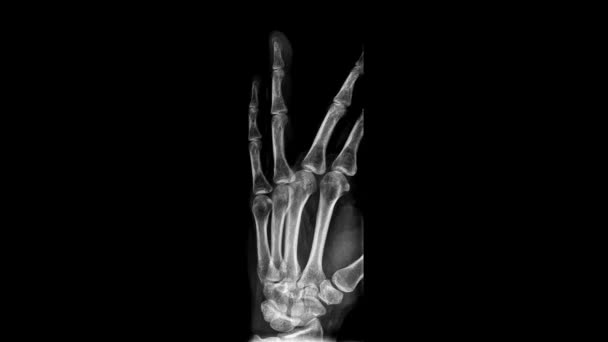Цикл Анимации Рентгеновского Сканирования Человеческой Ладони Хронология Монохромного Рентгеновского Изображения — стоковое видео